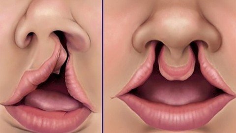 Cleft Lip And Palate- A Dental  Deformity 261125b21e2b56c2d9c6aa8d3e458fc2