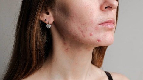 Udemy – Acne Management 2024