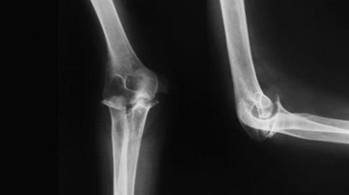 Radiology X-Ray of Elbow and  Forearm 37226ac06a6632973f5a2c3adafb4f36